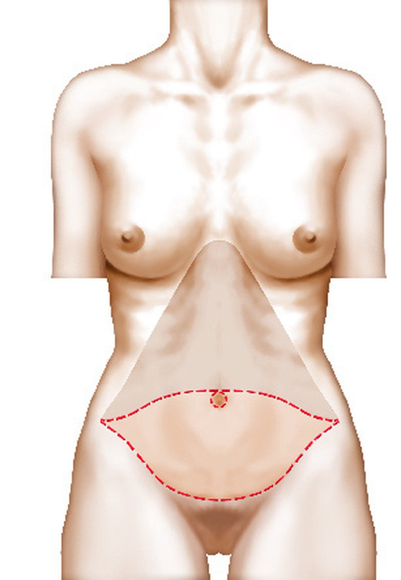 chirurgie esthétique ventre