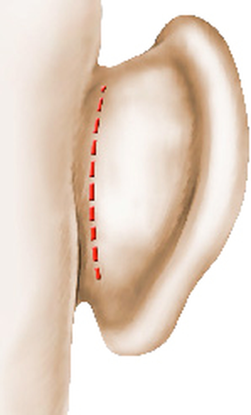 chirurgie oreilles decollees