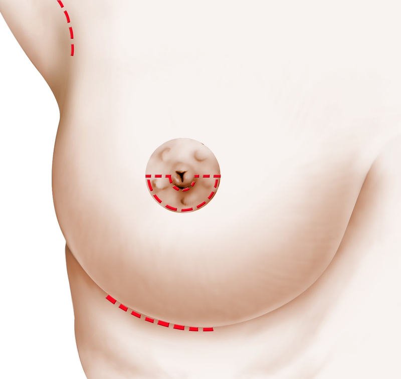 lipofilling mammaire