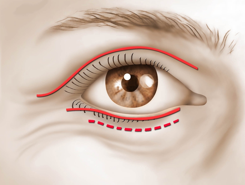 anesthésie chirurgie des paupières